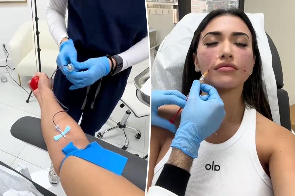 Next-gen filler craze uses your own blood - but docs warn it's 'unreliable'